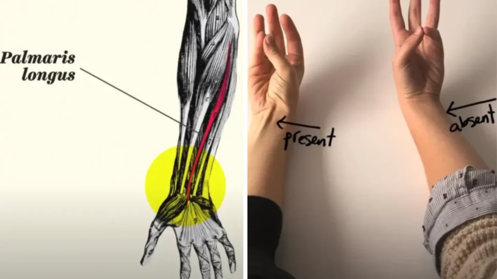 Discover what this raised tendon means if you concur your pinky finger with your thumb.