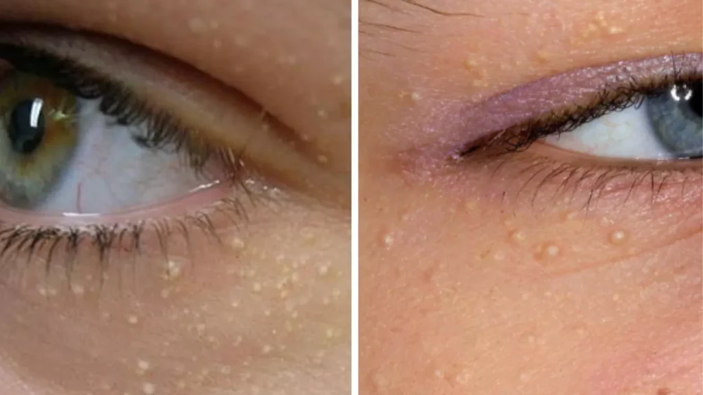 Why You Should Never Try to Remove Tiny White Bumps on Your Face